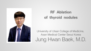 RF Ablation of thyroid nodules（射频消融治疗甲状腺结节）