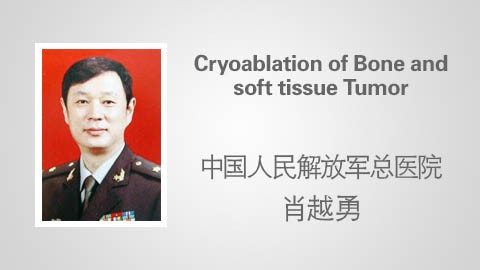 Cryoablation of Bone and soft tissue Tumor