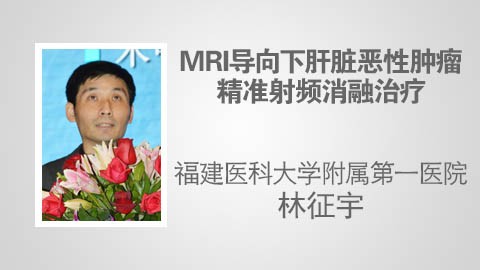 MRI导向下肝脏恶性肿瘤精准射频消融治疗